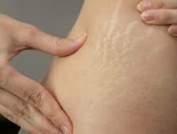 Stretch Mark: Penyebab dan Cara Menghilangkannya